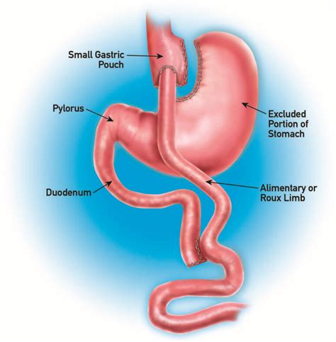what weight for gastric bypass